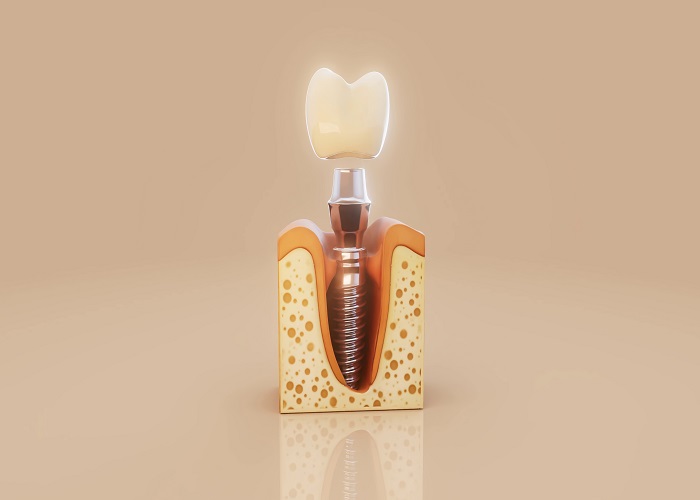 بهترین دکتر ایمپلنت دندان در اصفهان